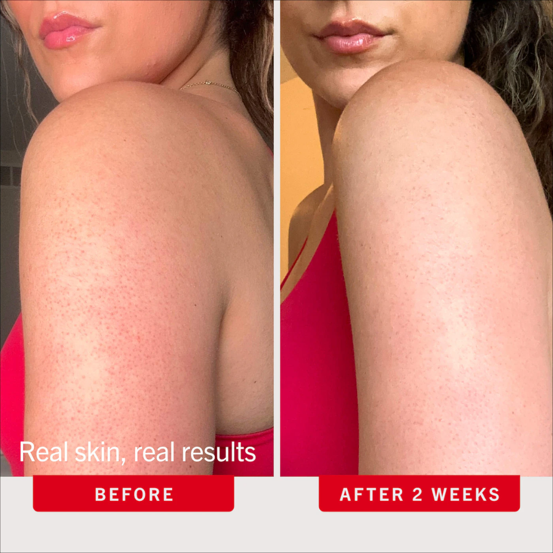 First Aid Beauty  KP Bump Eraser Body Scrub with 10% AHA – Body Exfoliant for Keratosis Pilaris